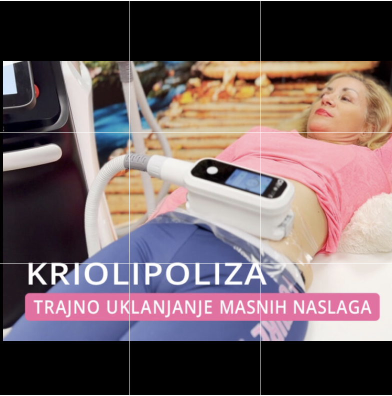 kriolipoliza-zamrzavanje-masnih-stanica-trajno-0919898289